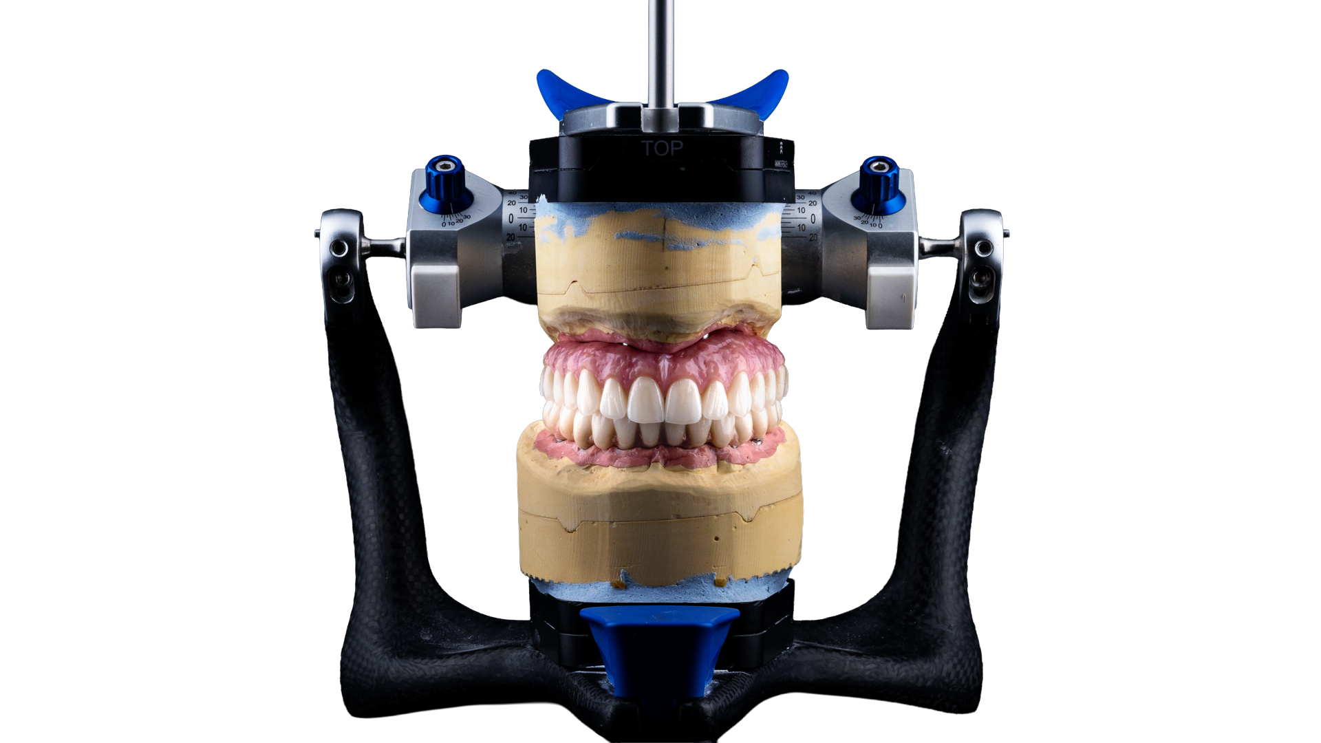 Peak Signature all-on-X full-arch restoration mounted on articulator