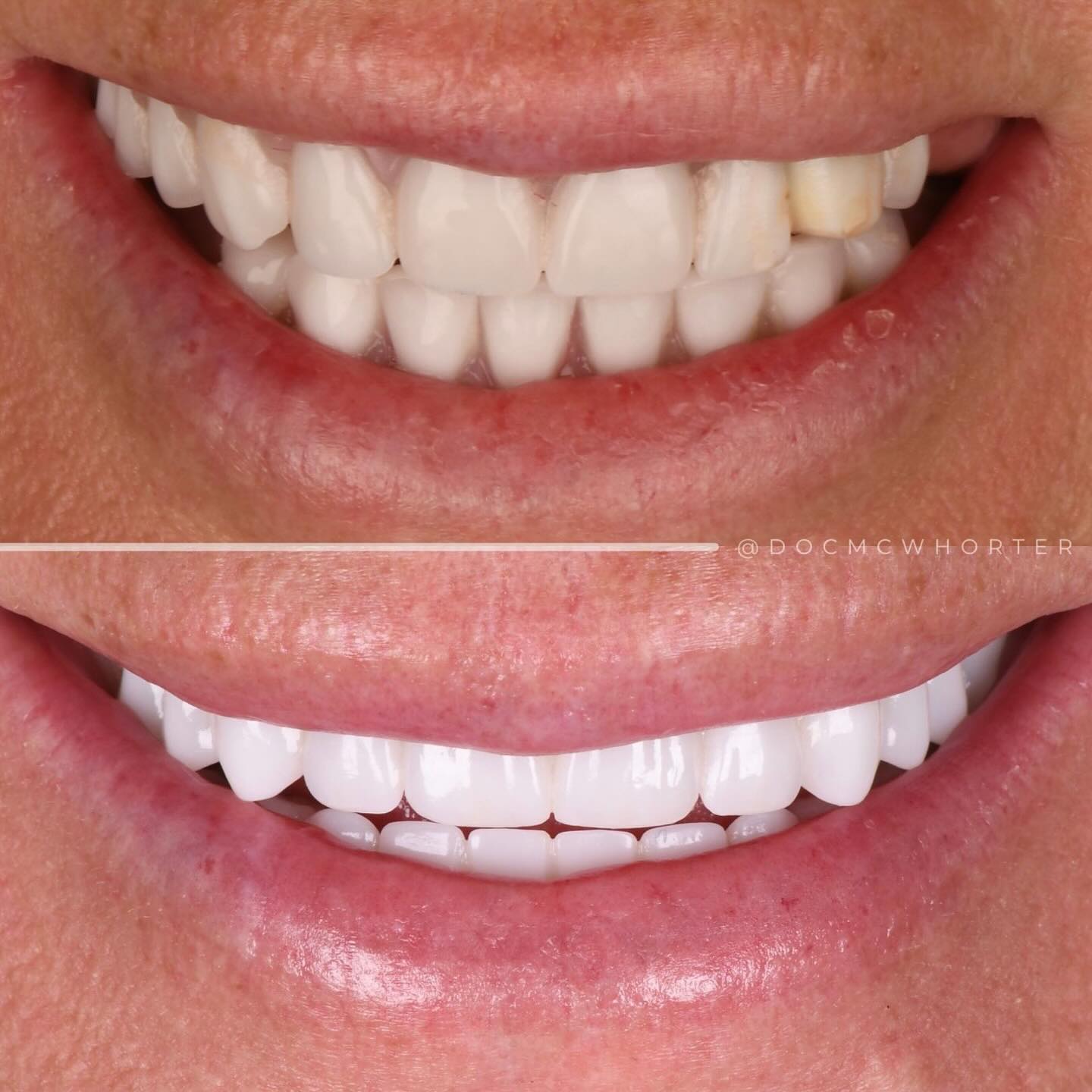 Full-arch All-on-X hybrid prosthesis, before and after