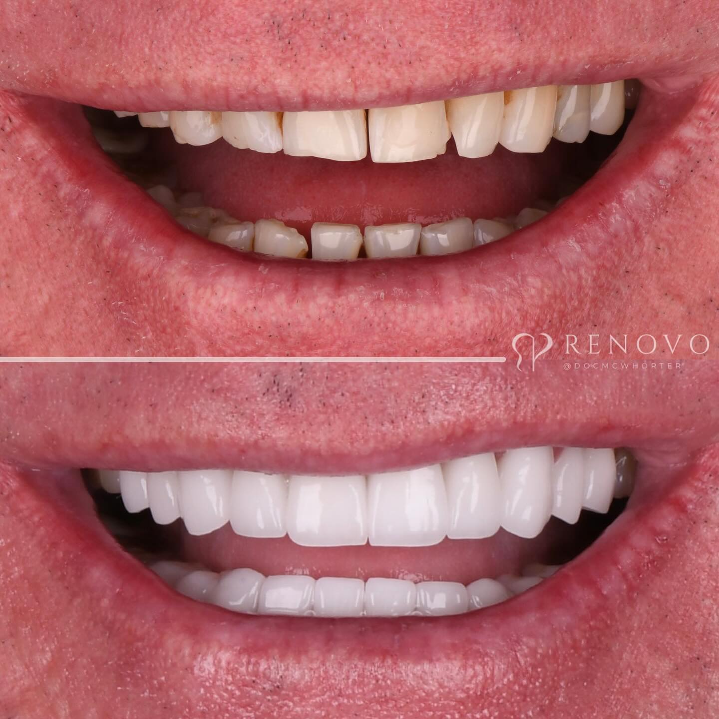 Twenty zirconia crown full-mouth rehabilitation, before and after