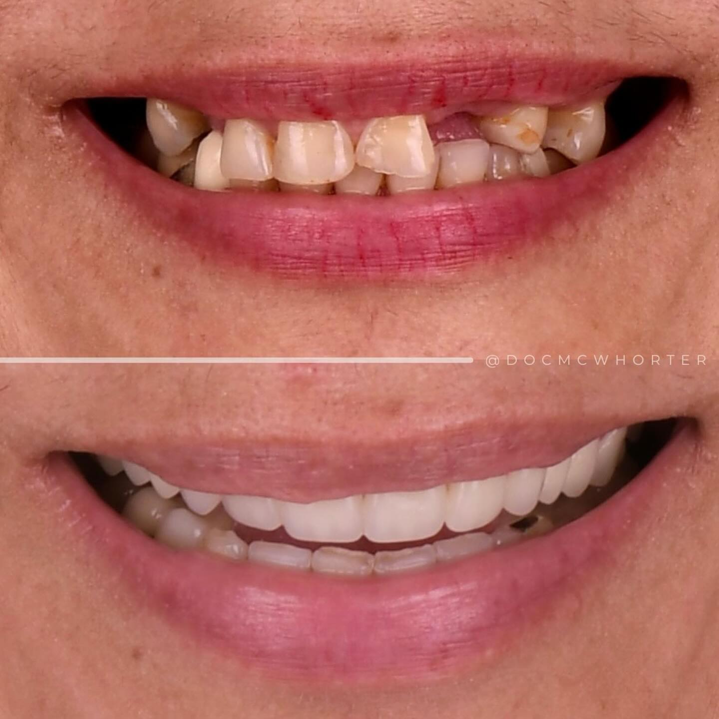 Upper All-on-X full-arch with natural lower dentition preserved