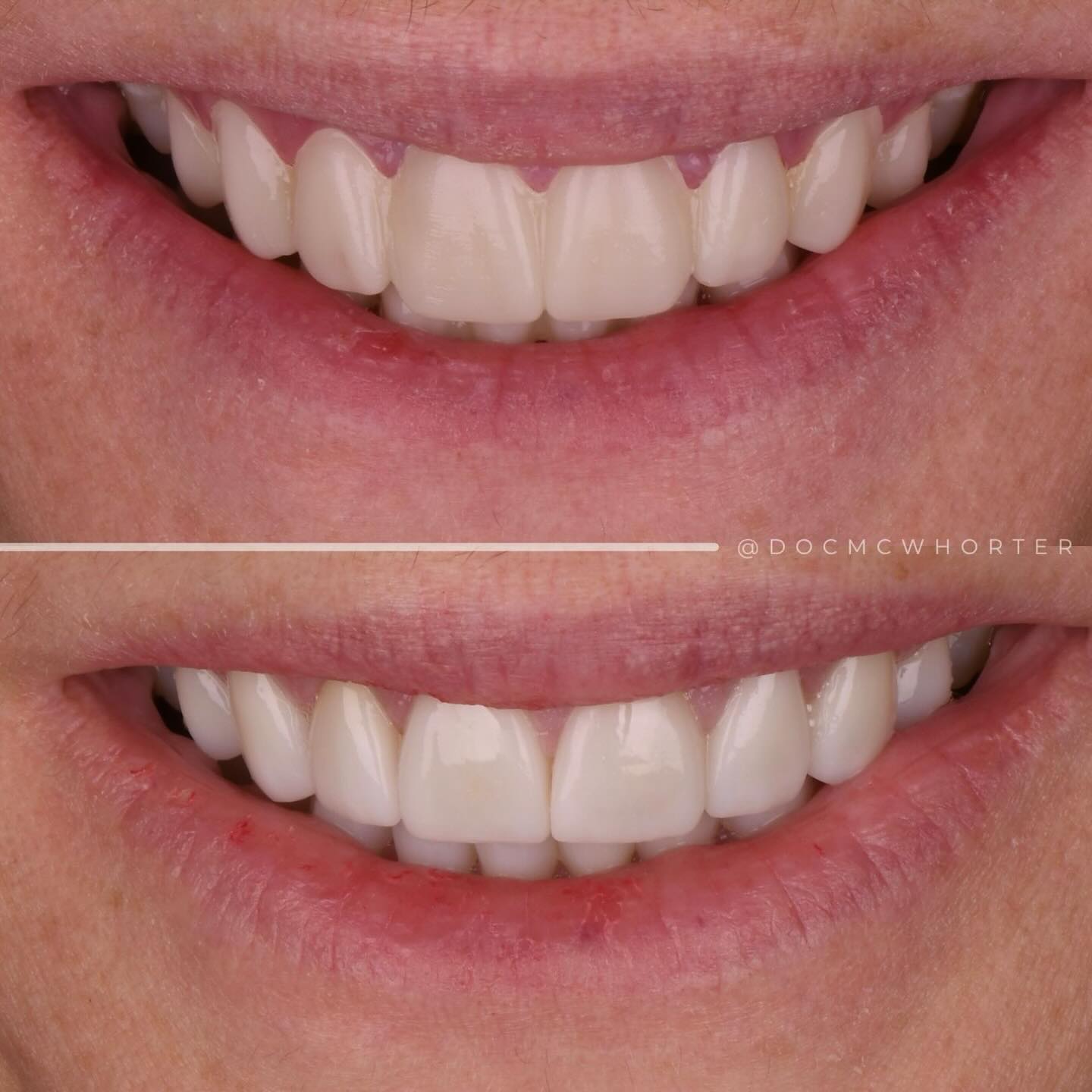 Veneer set transitioned from another lab's provisionals, before and after