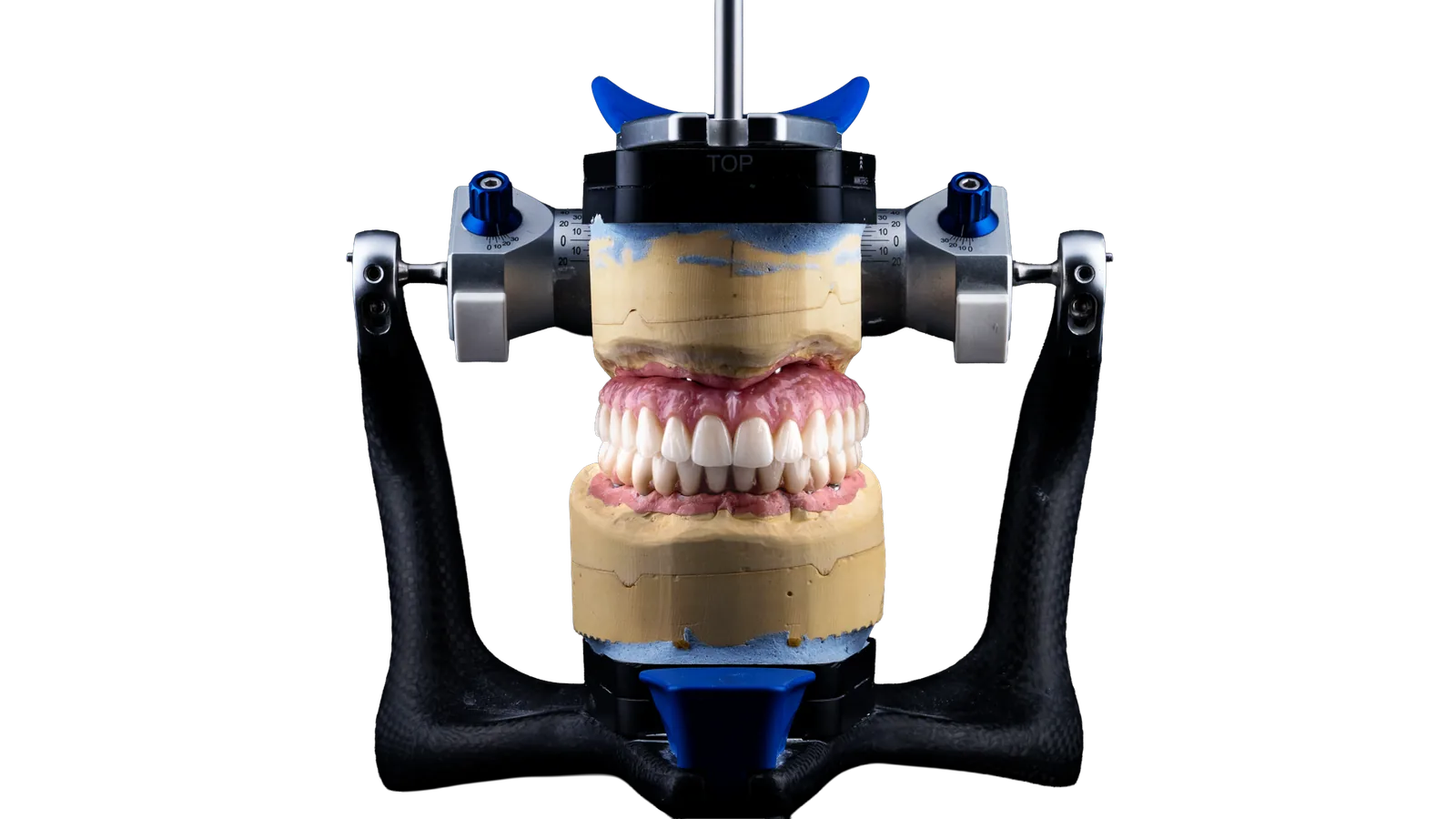 Peak Signature all-on-X full-arch restoration mounted on articulator