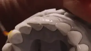 Veneer case viewed from an editorial perspective